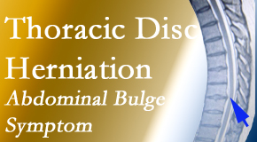 Amelia Chiropractic Clinic treats thoracic disc herniation that for some patients prompts abdominal pain.