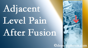 Amelia Chiropractic Clinic offers relieving care non-surgically to back pain patients suffering with adjacent level pain after spinal fusion surgery.