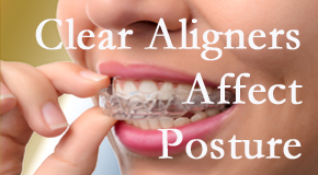 Clear aligners influence posture which Fernandina Beach chiropractic helps.