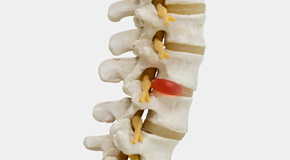 Fernandina Beach chiropractic conservative care helps even huge disc herniations go away