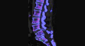 Amelia Chiropractic Clinic is aware that inflammatory spinal gout is a differential diagnosis to consider for patients who present with back pain and other spine related symptoms.