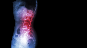 Fernandina Beach Chiropractic Care of Spondylolisthesis 
