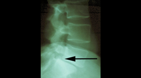 Fernandina Beach spondylolisthesis 