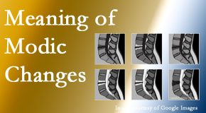 Amelia Chiropractic Clinic sees many back pain and neck pain patients who bring their MRIs with them to the office. Modic changes are often noted. 