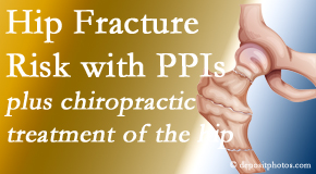 Amelia Chiropractic Clinic shares new research describing increased risk of hip fracture with proton pump inhibitor use. 