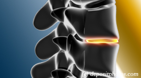 Fernandina Beach degenerative spinal changes 