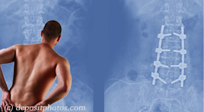 Fernandina Beach chiropractic relief for back pain after back surgery