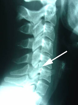 retrolisthesis subluxation