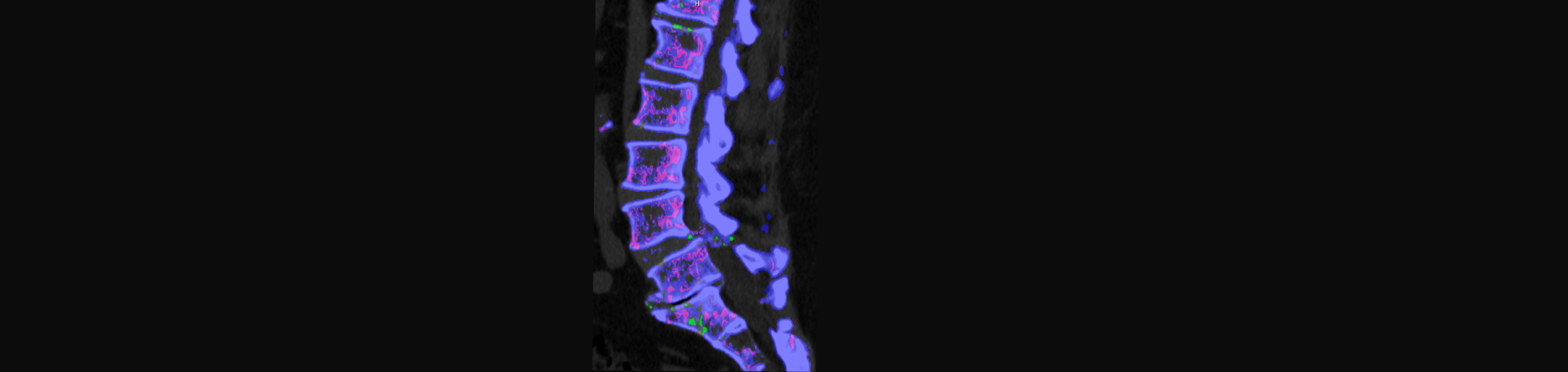 Amelia Chiropractic Clinic is aware that inflammatory spinal gout is a differential diagnosis to consider for patients who present with back pain and other spine related symptoms.