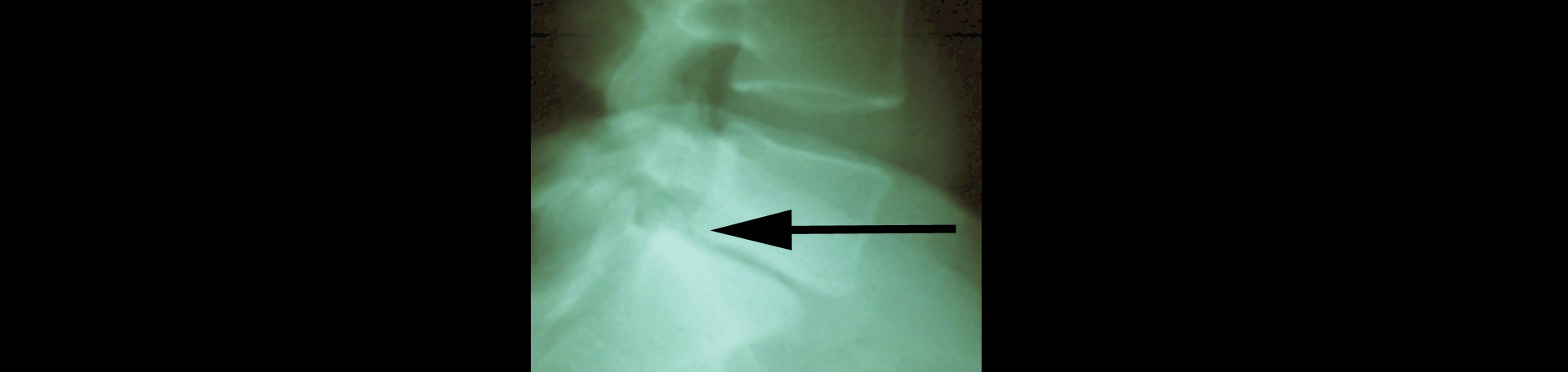 Fernandina Beach spondylolisthesis
