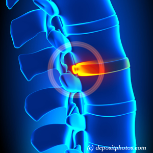 picture of lumbar Fernandina Beach disc herniation