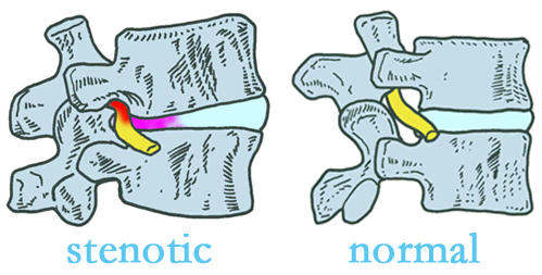 Fernandina Beach stenotic and normal spinal discs